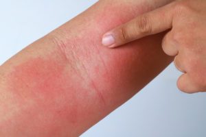 Eczema allergy skin, atopic dermatitis