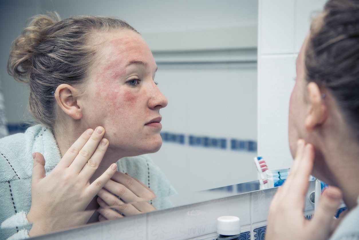 Feel Like Your Skin Is on Fire? Here's What You Need to Know About Eczema -  Intercoastal Medical Group