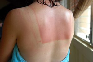 Sunburned Woman back after shower