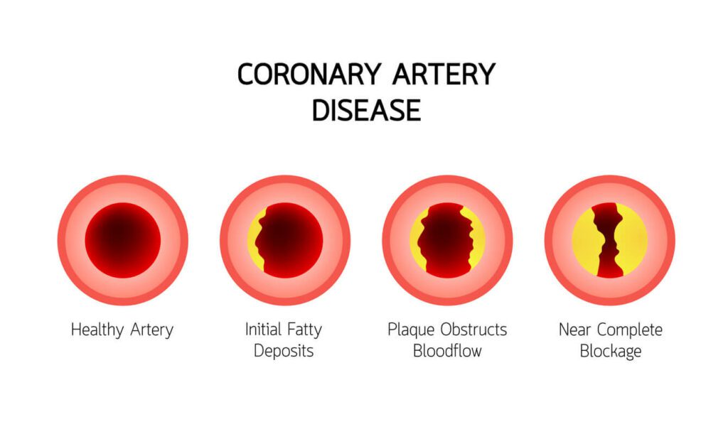 Coronary Artery Disease Treatment Near Me