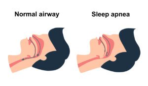 Obstructive sleep apnea syndrome concept vector illustration