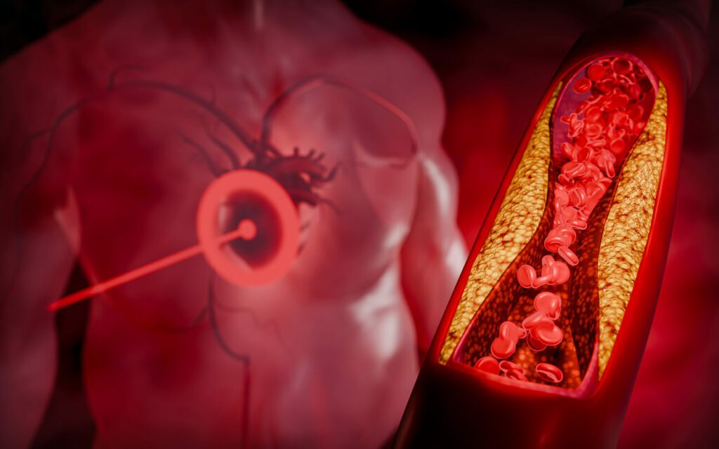 A graphical illustration of a person with Hyperlipidemia.