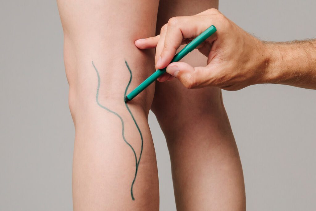 A vascular surgeon is marking veins for varicose surgery.