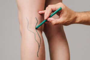 A vascular surgeon is marking veins for varicose surgery.