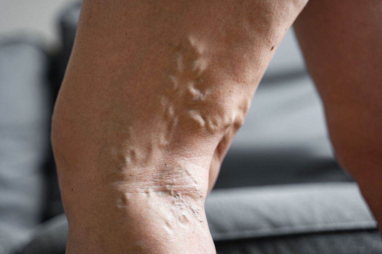 What Are My Treatment Options for Varicose Veins?