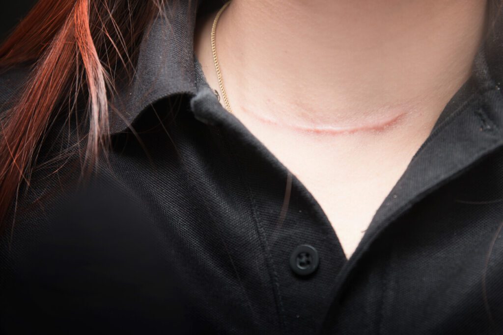 Scars on a woman's neck who is recovering from thyroid surgery.