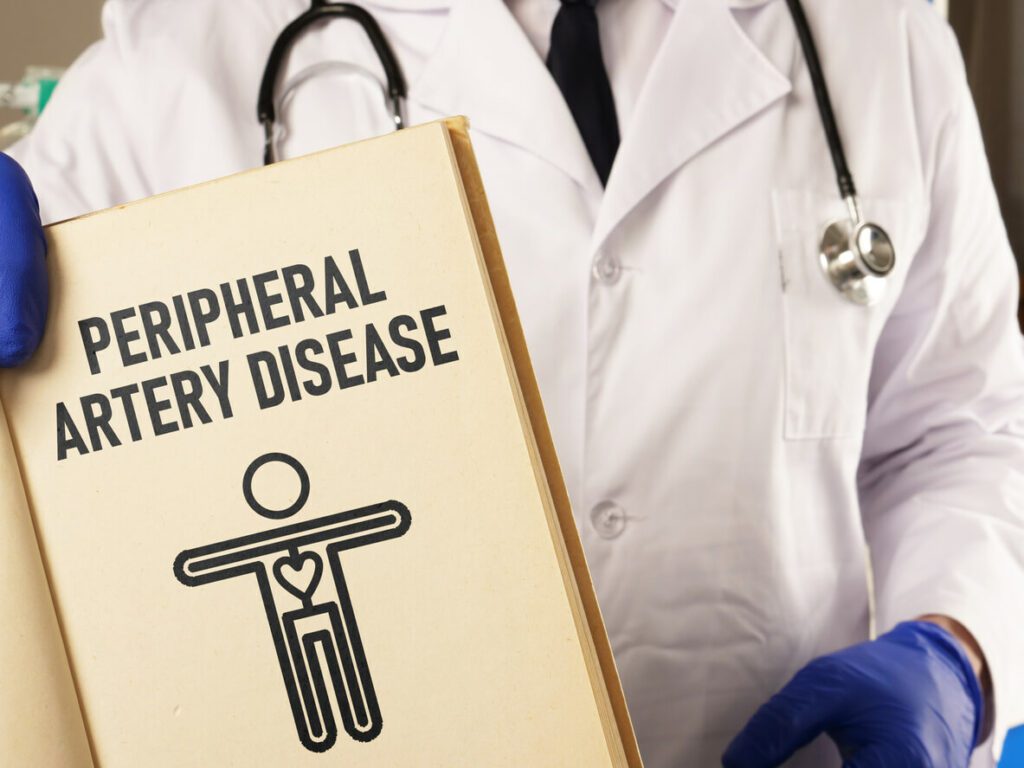 Peripheral artery disease PAD is shown using the text.